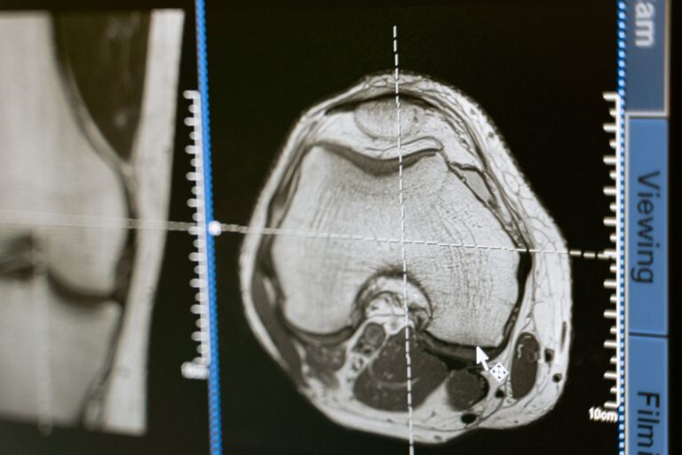 Segmentazione 3D della milza su volumi CT con MONAI e UNet